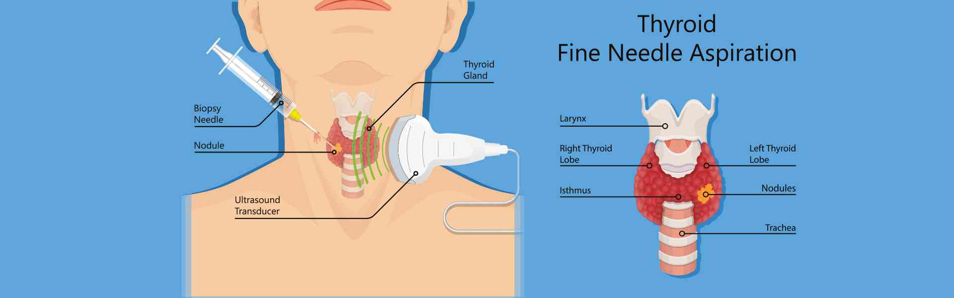 Fine Needle Aspiration Cytology Procedure in Goa Fine Needle Aspiration Cytology Procedure