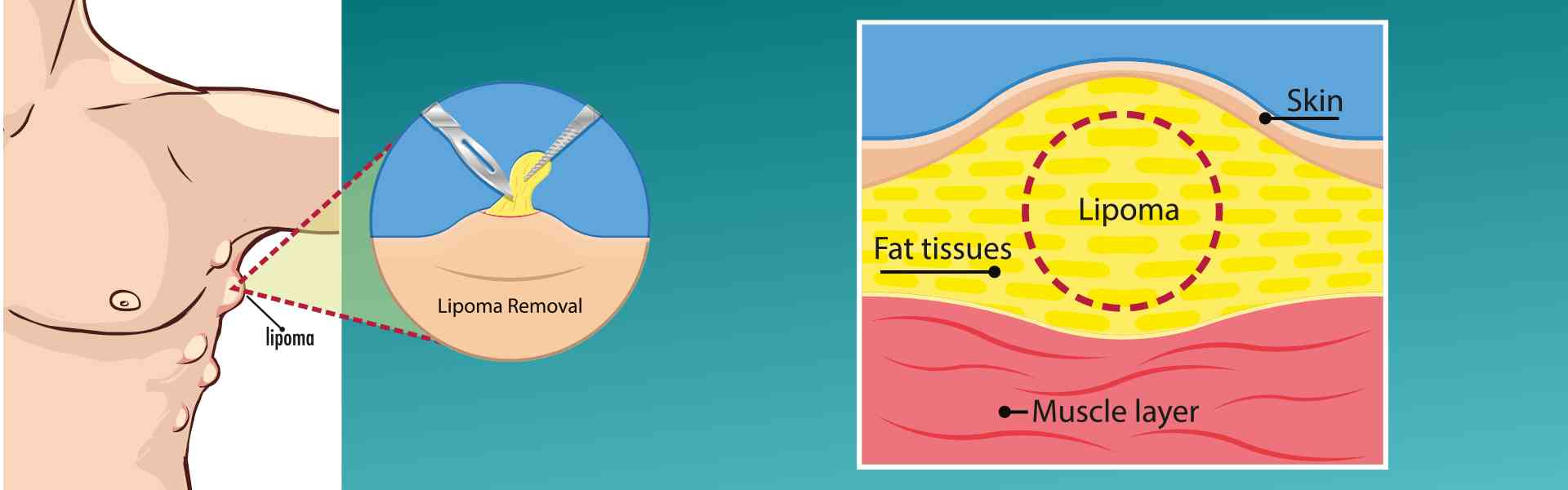 Lipoma Removal Treatment in Goa Lipoma Removal Treatment in Goa