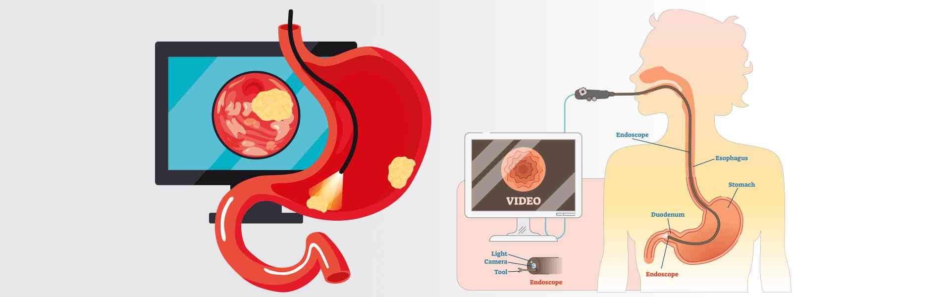 OGD - Oesophago-gastro Duodenoscopy treatment in Goa OGD - Oesophago-gastro Duodenoscopy treatment-Goa