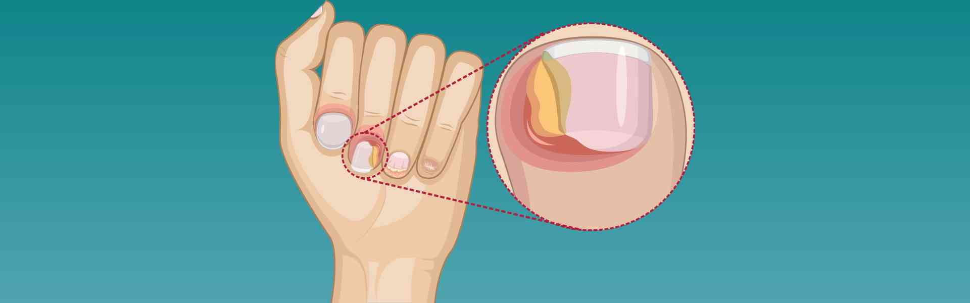Paronychia Nail Infection Treatment in Goa Paronychia Nail Infection Treatment in Goa