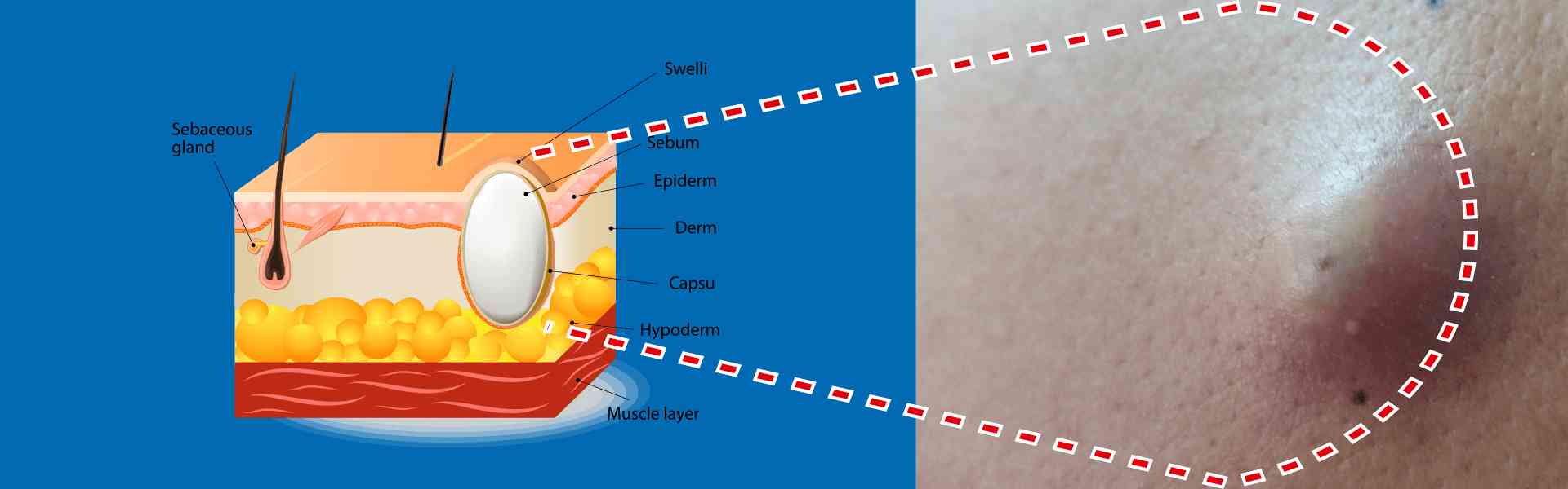 Sebaceous Cysts Surgery in Goa Sebaceous Cysts Surgery in Goa