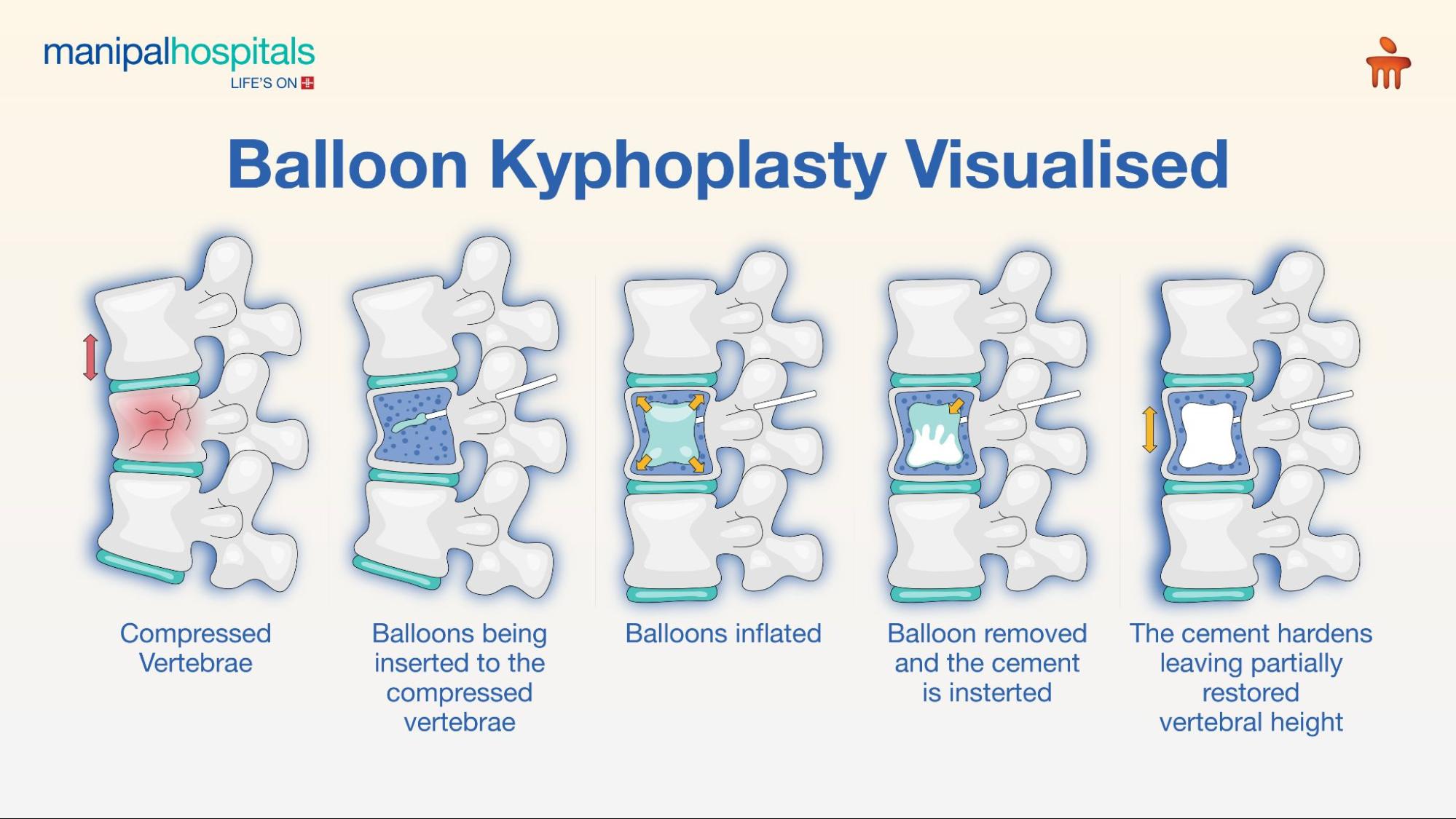 baloon