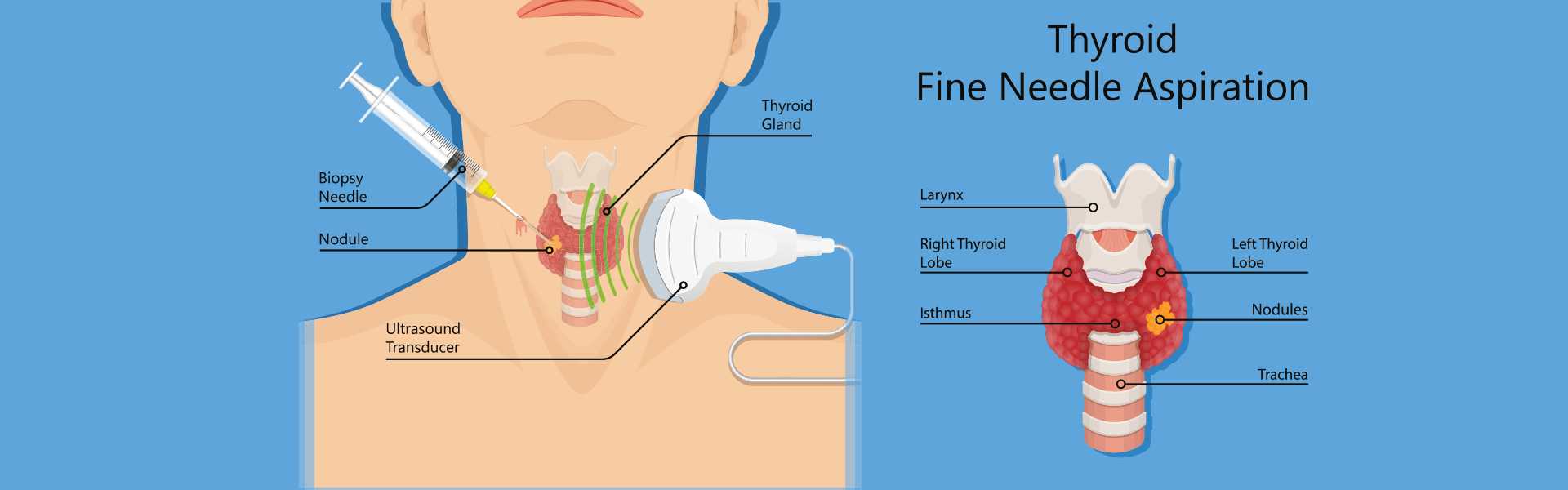 FNAC Procedure in Bangalore FNAC Treatment Procedure in Bangalore