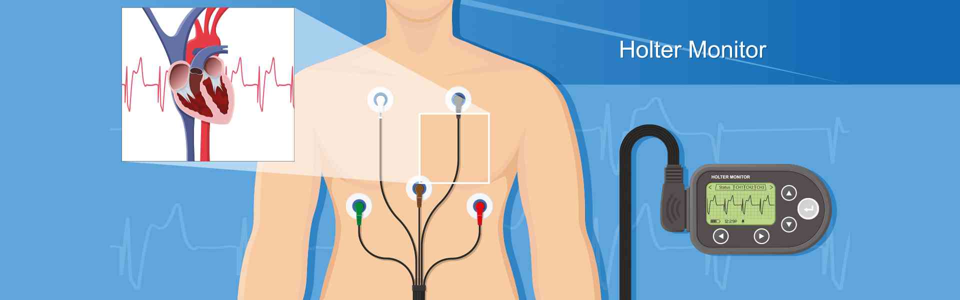 Holter Procedure specialist in Sarjapur Road, Bangalore Holter Procedure specialist in Sarjapur Road