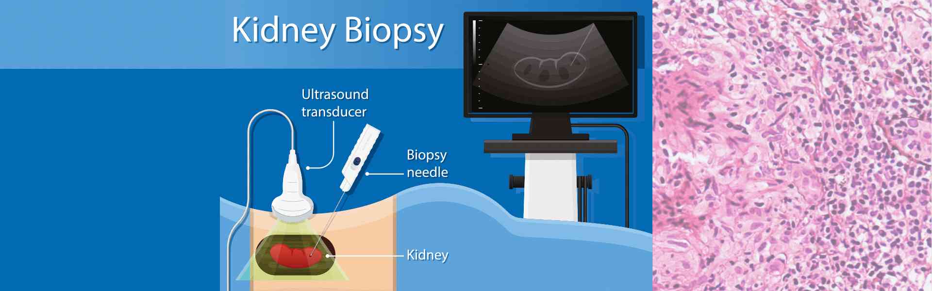 Kidney Biopsy Treatment in Sarjapur Road, Bangalore Kidney Biopsy Treatment in Sarjapur Road
