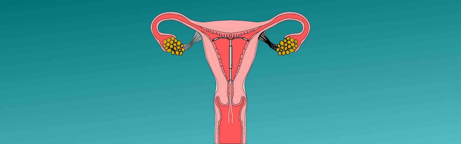 Iud Placement Centres in Sarjapur Road