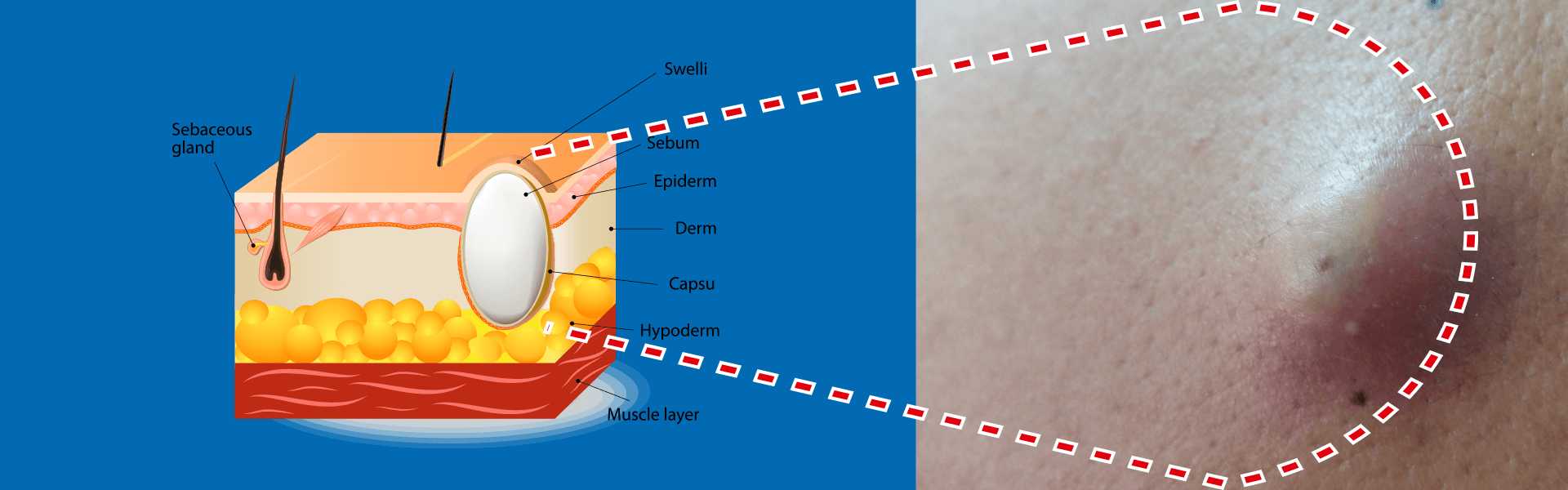 Sebaceous Cysts Treatment in Bangalore Sebaceous Cysts Treatment Procedure in Bangalore