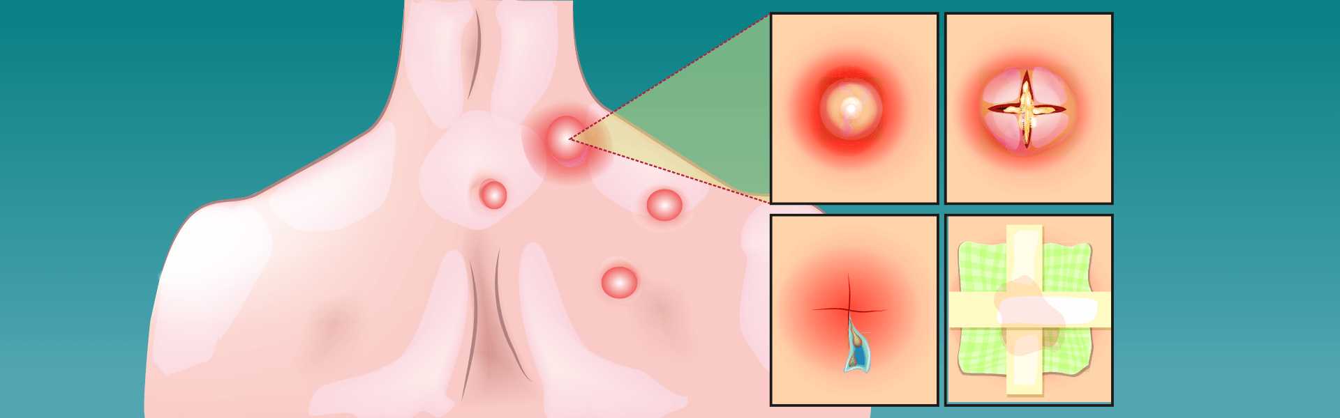 Skin Abscess Treatment in Bangalore Skin Abscess Treatment Hospital in Bangalore