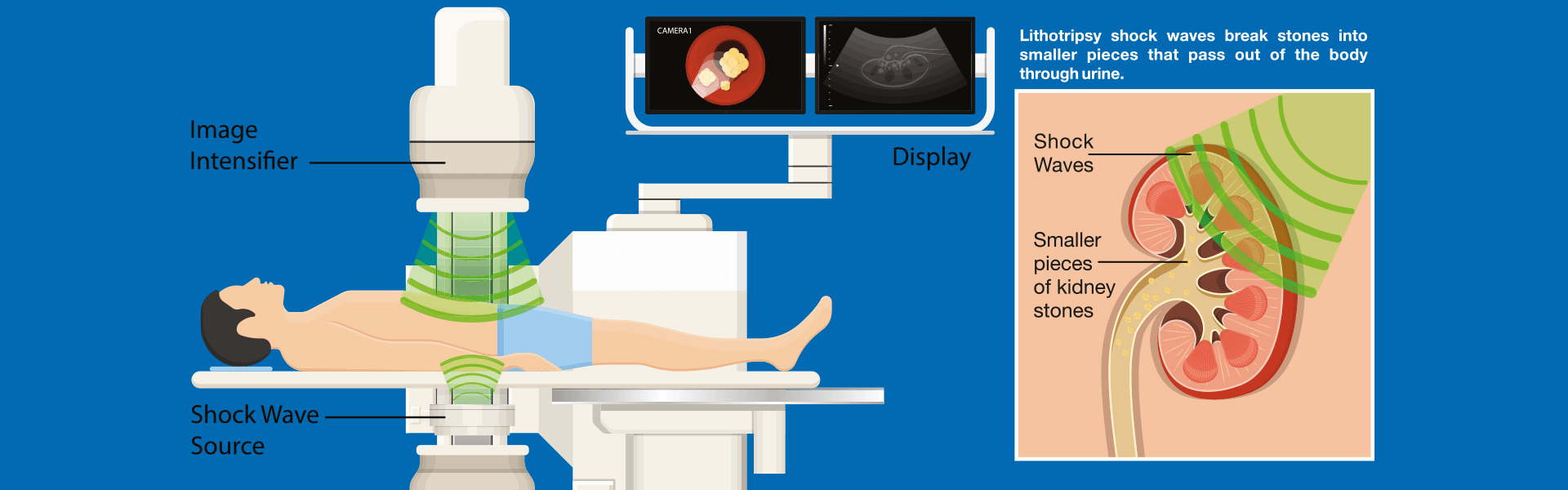 lithotripsy surgery in Bangalore